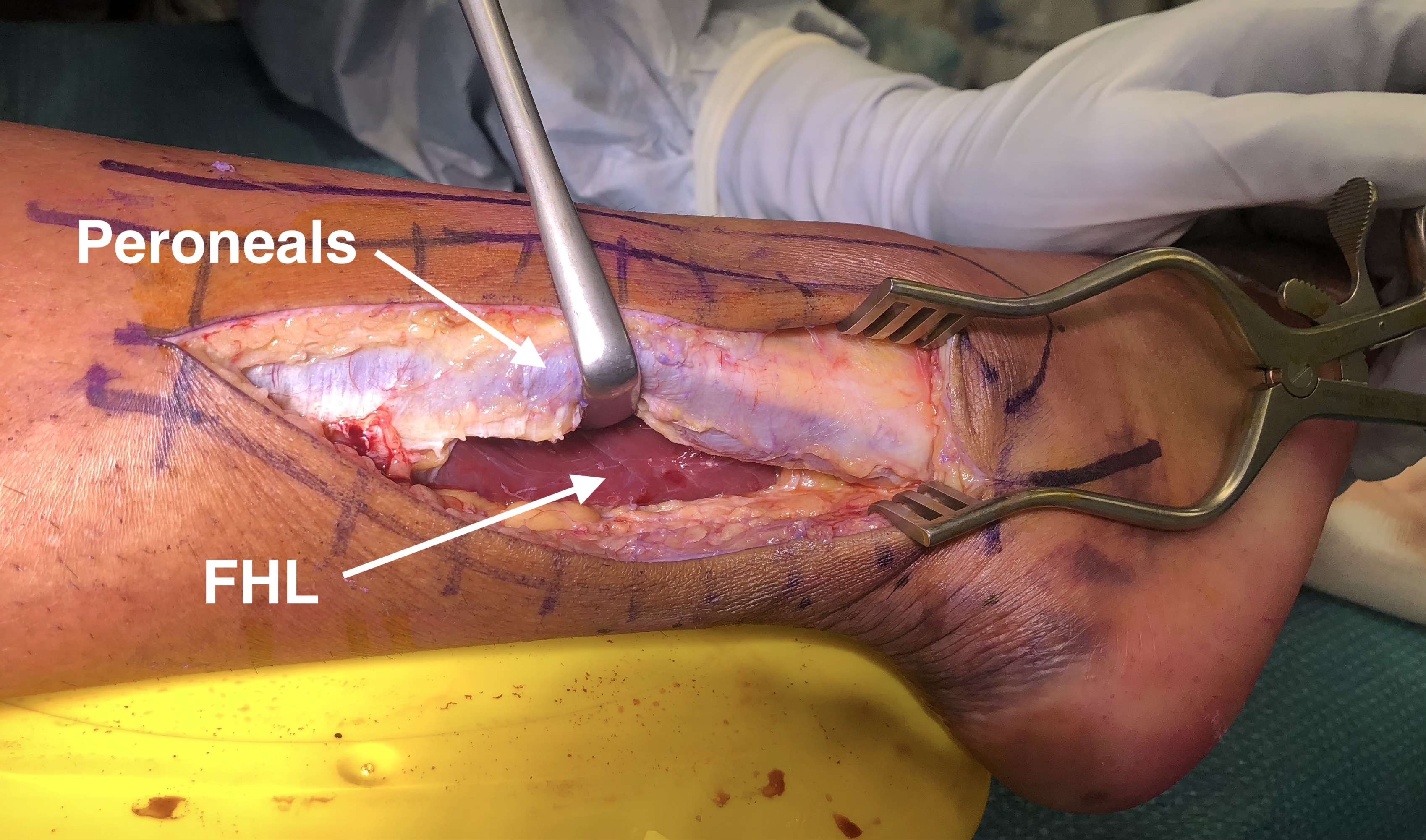 Ankle PL Approach 4